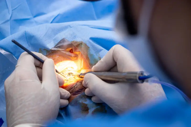 Understanding Cataract Surgery